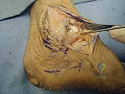 تقييم درجة عدم استقرار الكاحل بالأشعة