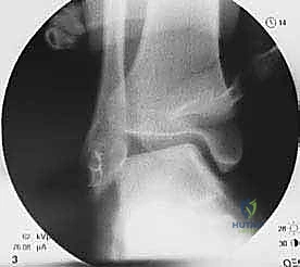 Illustration of interference screw fixation - Dr. Mohammed Hutaif