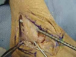 حفر الأنفاق العظمية في الشظية والكاحل