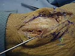 صورة توضيحية لـ إعادة بناء أربطة الكاحل الجانبية بالطعوم: حل نهائي لعدم الاستقرار المزمن مع الأستاذ الدكتور محمد هطيف