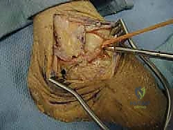 صورة توضيحية لـ إعادة بناء أربطة الكاحل الجانبية بالطعوم: حل نهائي لعدم الاستقرار المزمن مع الأستاذ الدكتور محمد هطيف