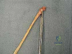 صورة توضيحية لـ إعادة بناء أربطة الكاحل الجانبية بالطعوم: حل نهائي لعدم الاستقرار المزمن مع الأستاذ الدكتور محمد هطيف