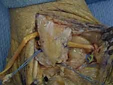 تأثير التمزق المزمن على غضاريف الكاحل