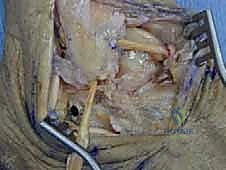 استخدام الرنين المغناطيسي لتقييم أربطة الكاحل