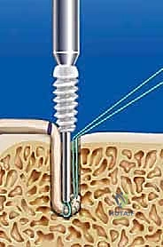 تحضير الطعم الليفي (Allograft) في غرفة العمليات