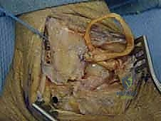 صورة طبية: إعادة بناء أربطة الكاحل الجانبية بالطعوم: حل نهائي لعدم الاستقرار المزمن مع الأستاذ الدكتور محمد هطيف