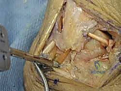 صورة طبية: إعادة بناء أربطة الكاحل الجانبية بالطعوم: حل نهائي لعدم الاستقرار المزمن مع الأستاذ الدكتور محمد هطيف