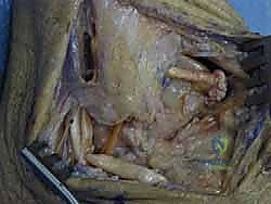 صورة طبية: إعادة بناء أربطة الكاحل الجانبية بالطعوم: حل نهائي لعدم الاستقرار المزمن مع الأستاذ الدكتور محمد هطيف