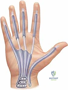 صورة توضيحية لـ علاج التهابات اليد العميقة: دليل شامل من الأستاذ الدكتور محمد هطيف في صنعاء