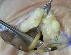 أعراض وعلامات التهابات اليد العميقة