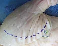 تشريح مسافات اليد العميقة والتهاباتها