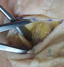 صورة توضيحية لـ علاج التهابات اليد العميقة: دليل شامل من الأستاذ الدكتور محمد هطيف في صنعاء