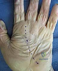 التحضير للتدخل الجراحي في اليد