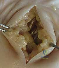 علاج التهابات اليد العميقة: دليل شامل من الأستاذ الدكتور محمد هطيف في صنعاء