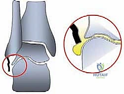 إعادة بناء أربطة الكاحل الجانبية التشريحية: خبرة الأستاذ الدكتور محمد هطيف باستخدام وتر العضلة الأخمصية في صنعاء