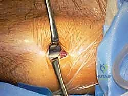 توضيح طبي: تجهيز وتر العضلة الأخمصية وتنظيفه قبل زراعته في الكاحل