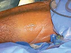 توضيح طبي: حفر الأنفاق العظمية الدقيقة في عظمة الشظية (Fibula)