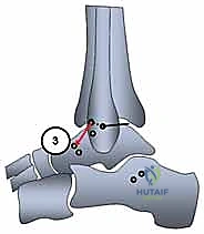 Illustration of plantaris longus tendon - Dr. Mohammed Hutaif