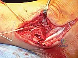 توضيح طبي: الإغلاق التجميلي للجلد لتقليل الندبات الجراحية إلى الحد الأدنى