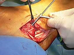 توضيح طبي: استخدام مسامير التداخل (Interference Screws) لتثبيت الوتر بقوة داخل العظم