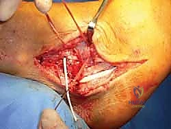 توضيح طبي: إغلاق الطبقات العميقة للشق الجراحي بعناية فائقة