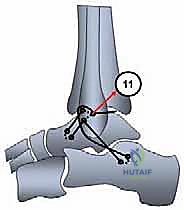 Anatomic Lateral Ankle Ligament Reconstruction: A Masterclass in Plantaris Longus Autograft Technique