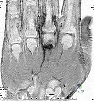 التهاب المفاصل الإنتاني في اليد والمعصم الأسباب الأعراض والعلاج المتقدم مع الأستاذ الدكتور محمد هطيف