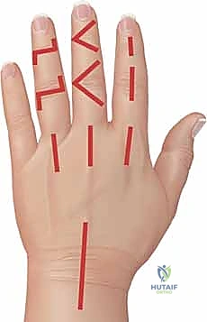 صورة توضيحية لـ التهاب المفاصل الإنتاني في اليد والمعصم الأسباب الأعراض والعلاج المتقدم مع الأستاذ الدكتور محمد هطيف