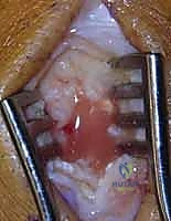 Illustration of treatment of septic - Dr. Mohammed Hutaif