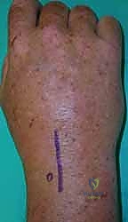 التشخيص الدقيق لالتهاب المفاصل الإنتاني