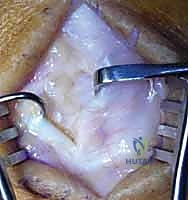 صورة توضيحية لـ التهاب المفاصل الإنتاني في اليد والمعصم الأسباب الأعراض والعلاج المتقدم مع الأستاذ الدكتور محمد هطيف