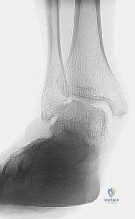 Mastering Deltoid Ligament Reconstruction: An Intraoperative Guide