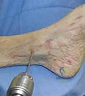 الخيارات العلاجية لتمزق الرباط الدالي