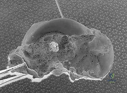 خطوات الجراحة الدقيقة لإصلاح الكاحل