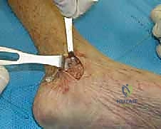 صورة توضيحية لـ إعادة بناء الرباط الدالي للكاحل: دليل شامل للمرضى مع الأستاذ الدكتور محمد هطيف