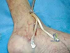 إعادة بناء الرباط الدالي للكاحل: دليل شامل للمرضى مع الأستاذ الدكتور محمد هطيف