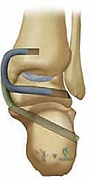 التشريح الدقيق للرباط الدالي للكاحل