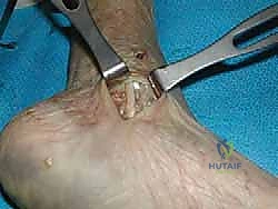 صورة توضيحية لـ إعادة بناء الرباط الدالي للكاحل: دليل شامل للمرضى مع الأستاذ الدكتور محمد هطيف