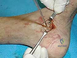 تثبيت الطعم العظمي والرباط الجديد في الكاحل