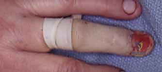 أخذ رقعة نسيجية لإعادة البناء