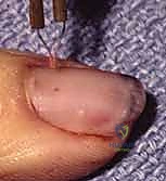 الجراحة المجهرية لإصلاح مصفوفة الظفر