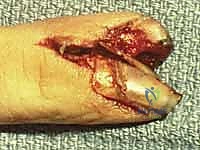 صورة توضيحية لـ إصلاح وإعادة بناء واستئصال مصفوفة الظفر