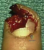 تثبيت الدعامة بالخيوط الجراحية