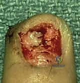 إعادة وضع صفيحة الظفر كدعامة