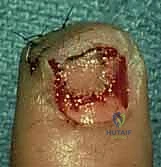 الضمادات الطبية بعد الجراحة