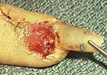 إصلاح وإعادة بناء واستئصال مصفوفة الظفر: دليل شامل للمرضى مع الأستاذ الدكتور محمد هطيف