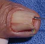 صورة توضيحية لـ إصلاح وإعادة بناء واستئصال مصفوفة الظفر: دليل شامل للمرضى مع الأستاذ الدكتور محمد هطيف