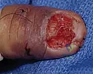 صورة توضيحية لـ إصلاح وإعادة بناء واستئصال مصفوفة الظفر: دليل شامل للمرضى مع الأستاذ الدكتور محمد هطيف