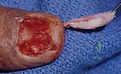 صورة توضيحية لـ إصلاح وإعادة بناء واستئصال مصفوفة الظفر: دليل شامل للمرضى مع الأستاذ الدكتور محمد هطيف