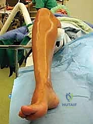 تحضير المريض للجراحة